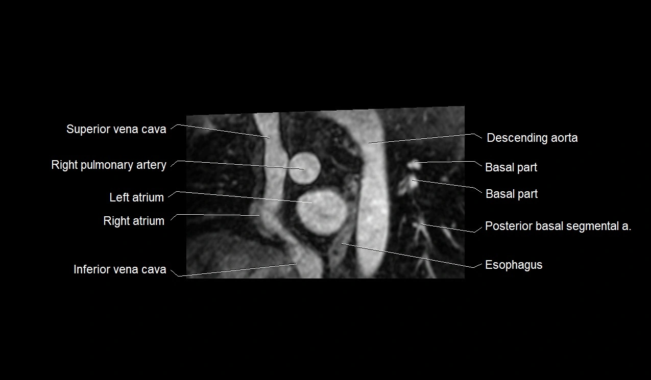 MRI heart and coronary arteries short axis anatomy image 6.webp